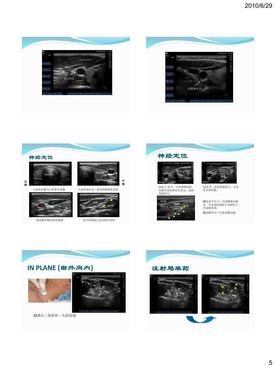 11.超声引导下神经阻滞-林惠华_第5页