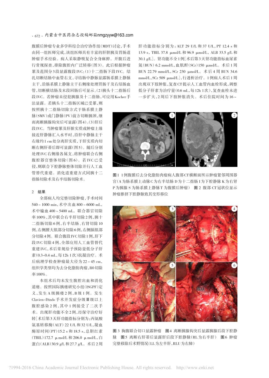 应用改良下腔静脉前入路法完整切除巨大腹膜后脂肪肉瘤10例临床分析_丘辉_李成鹏__第2页