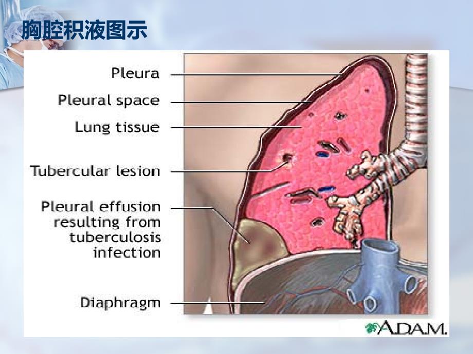 三大穿刺术(胸穿、腹穿、腰穿)_第3页