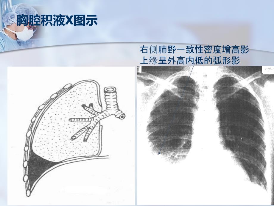 三大穿刺术(胸穿、腹穿、腰穿)_第4页