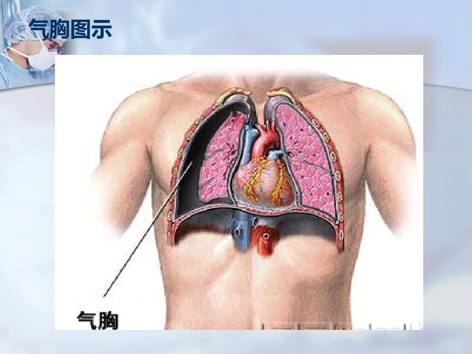 三大穿刺术(胸穿、腹穿、腰穿)_第5页