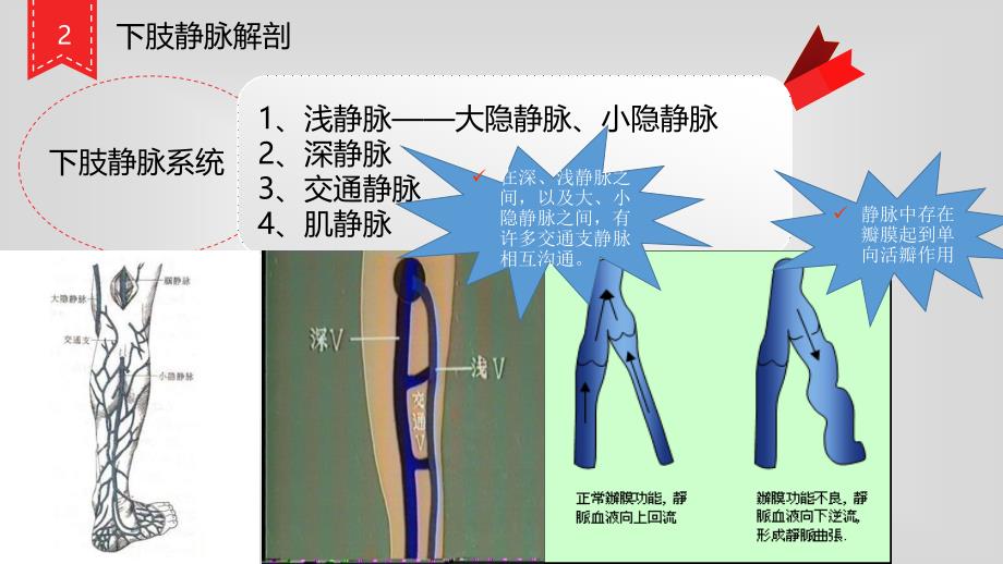 静脉曲张  ppt_第3页