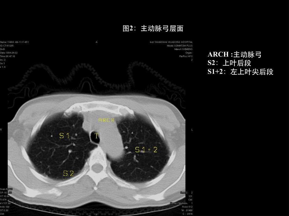 胸部断层CT_第2页