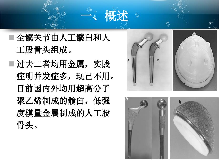 全髋关节置换术的教学查房_第4页