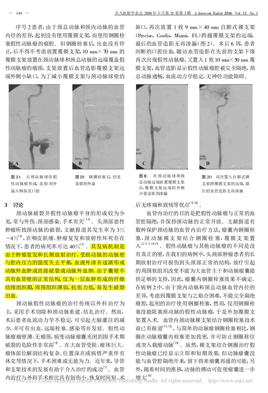 应用覆膜支架介入救治颈动脉破裂并假性动脉瘤2006_徐高峰_第3页