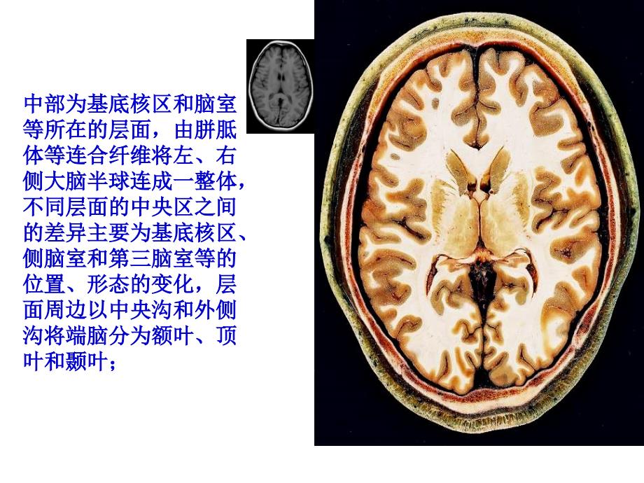 3颅脑连续横断层解剖_第4页