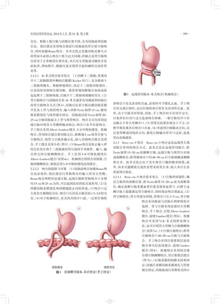 【最新】+胃切除术后消化道重建技术专家共识_第5页