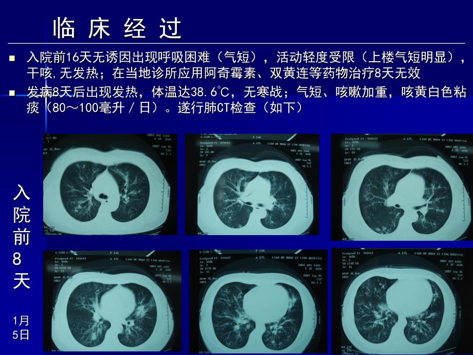 在临床实践中学习和认识肺曲霉病的临床多样性——陈佰义_第3页