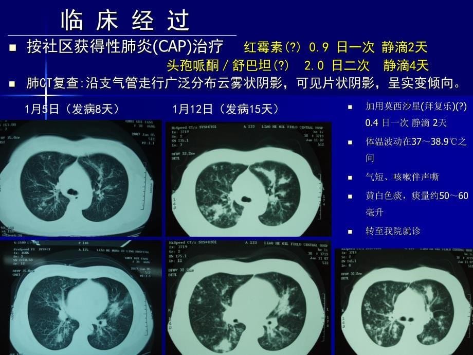 在临床实践中学习和认识肺曲霉病的临床多样性——陈佰义_第5页