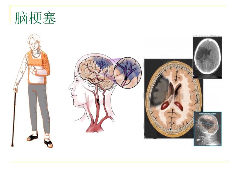 大动脉粥样硬化性脑梗塞_第3页