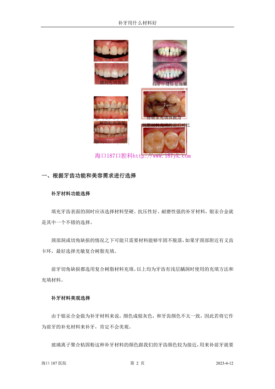 补牙用什么材料好47935_第2页