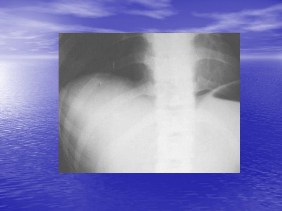 急腹症X线诊断医学课件_第3页