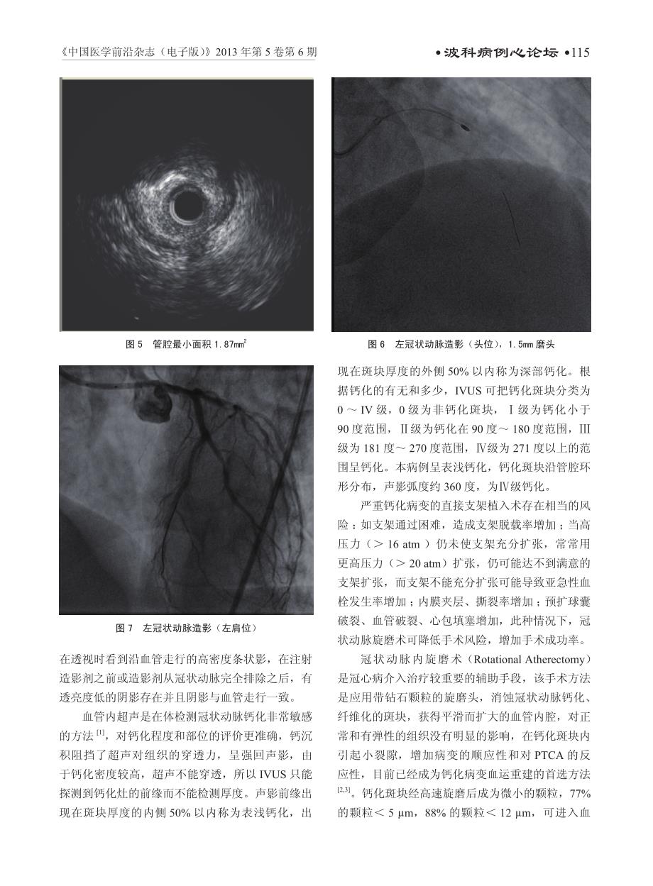 血管内超声指导旋磨治疗冠心病严重钙化病变1例_第3页