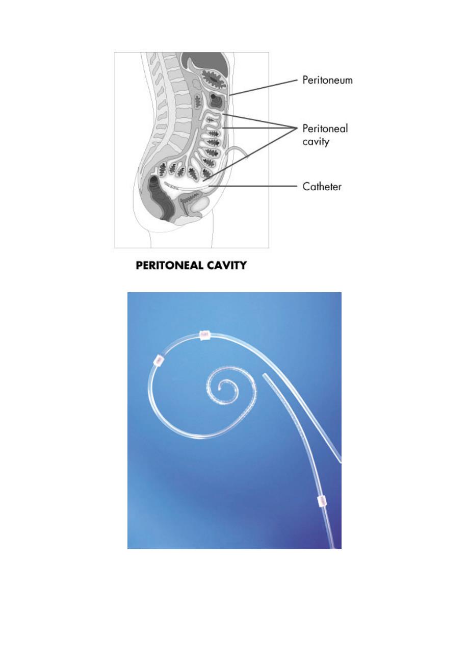 腹膜透析置管术-图解_第4页