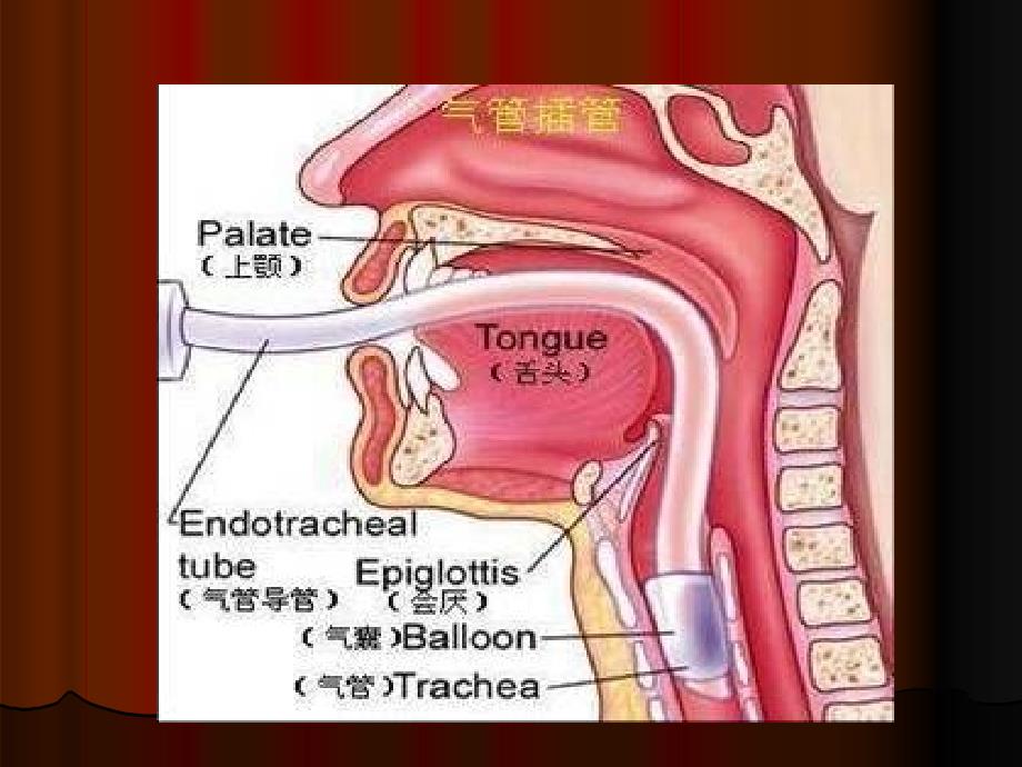 气管插管的护理配合_第4页