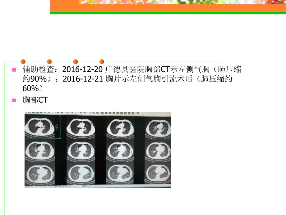 气胸  教学查房_第4页