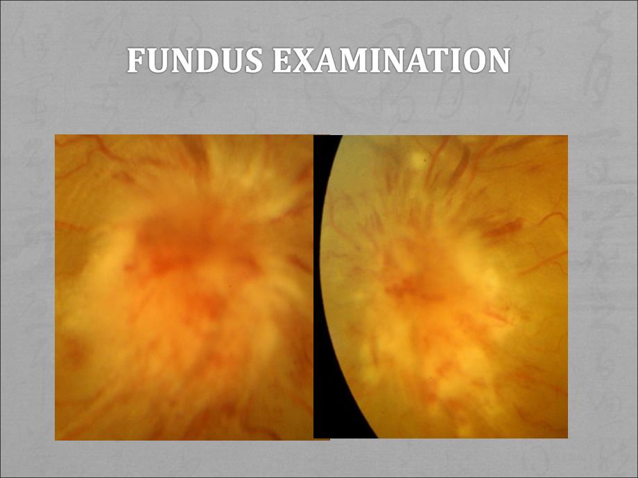 42 yo M with Blurred vision for 1+ week_第4页