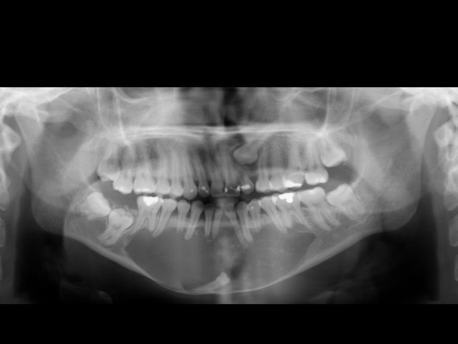 医学授课ppt讲义模板：牙齿病变与原理解析Anatomía radiográfica intraoral_第4页