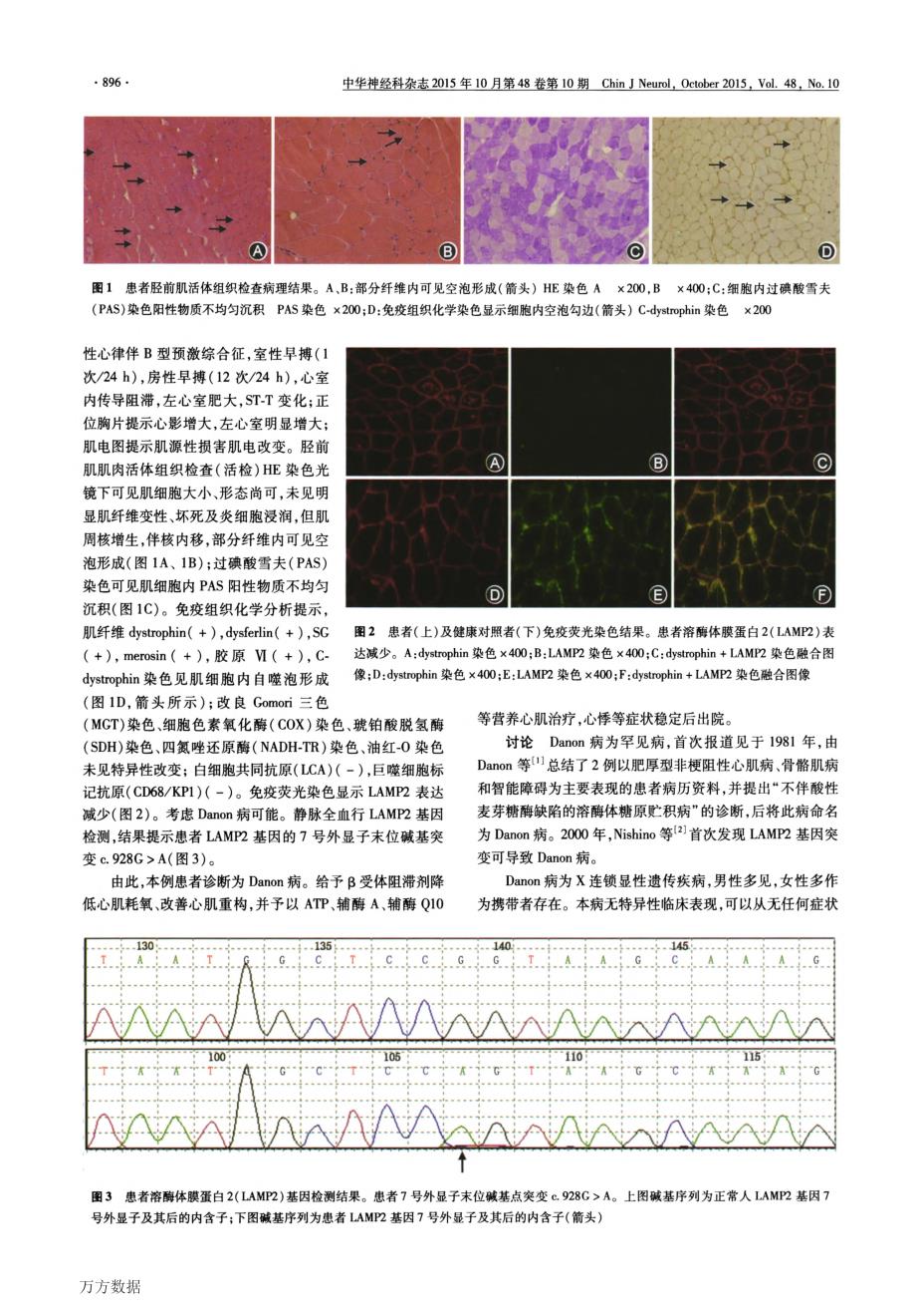 Danon病一例_第2页