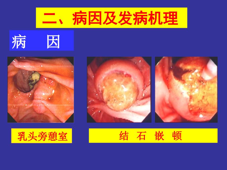 急性胰腺炎幻灯_第4页