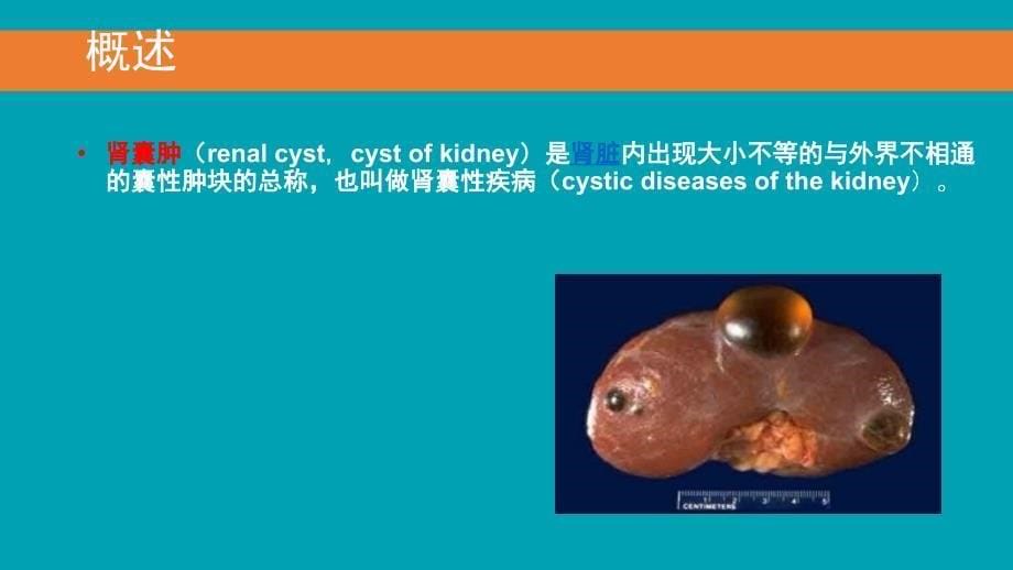 后腹腔镜下肾囊肿去顶减压术_第5页