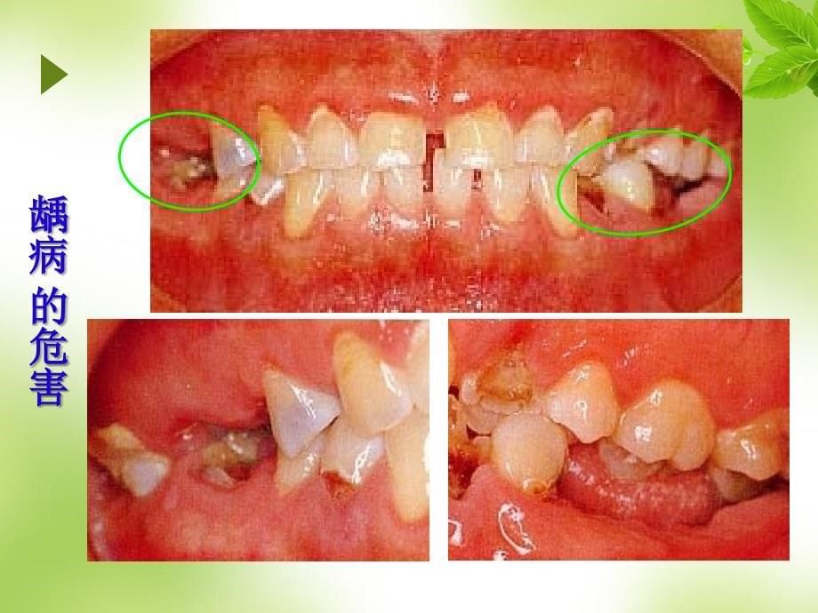 第八章--龋病_第5页