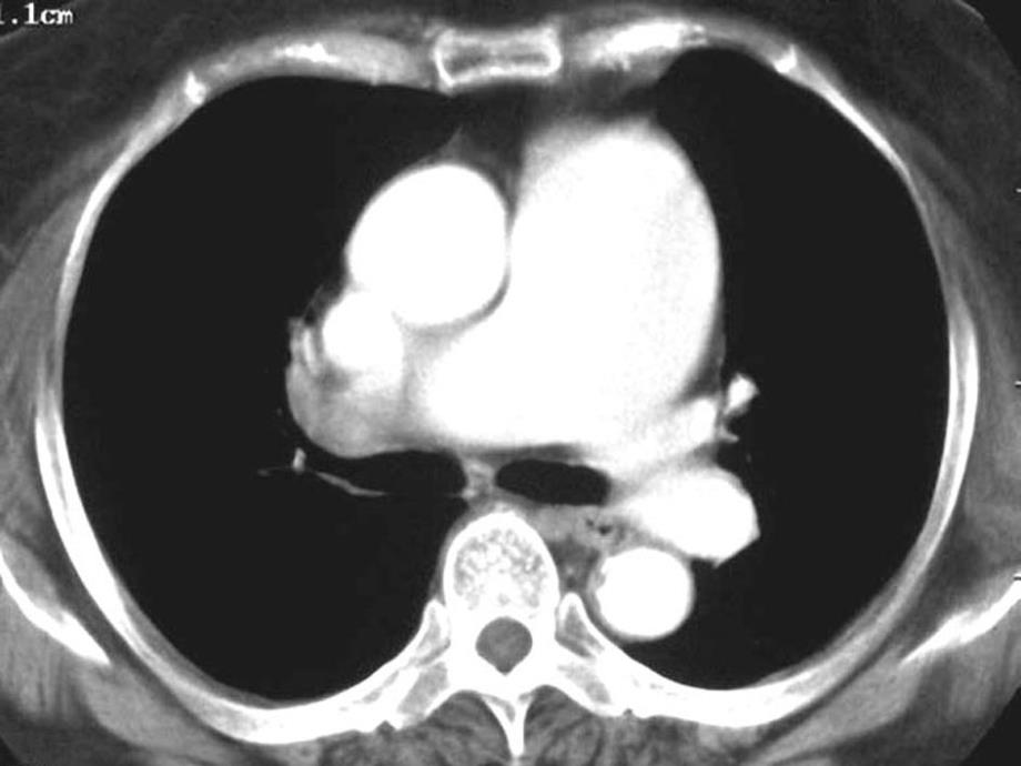 肺栓塞的影像诊断第二部分_第3页