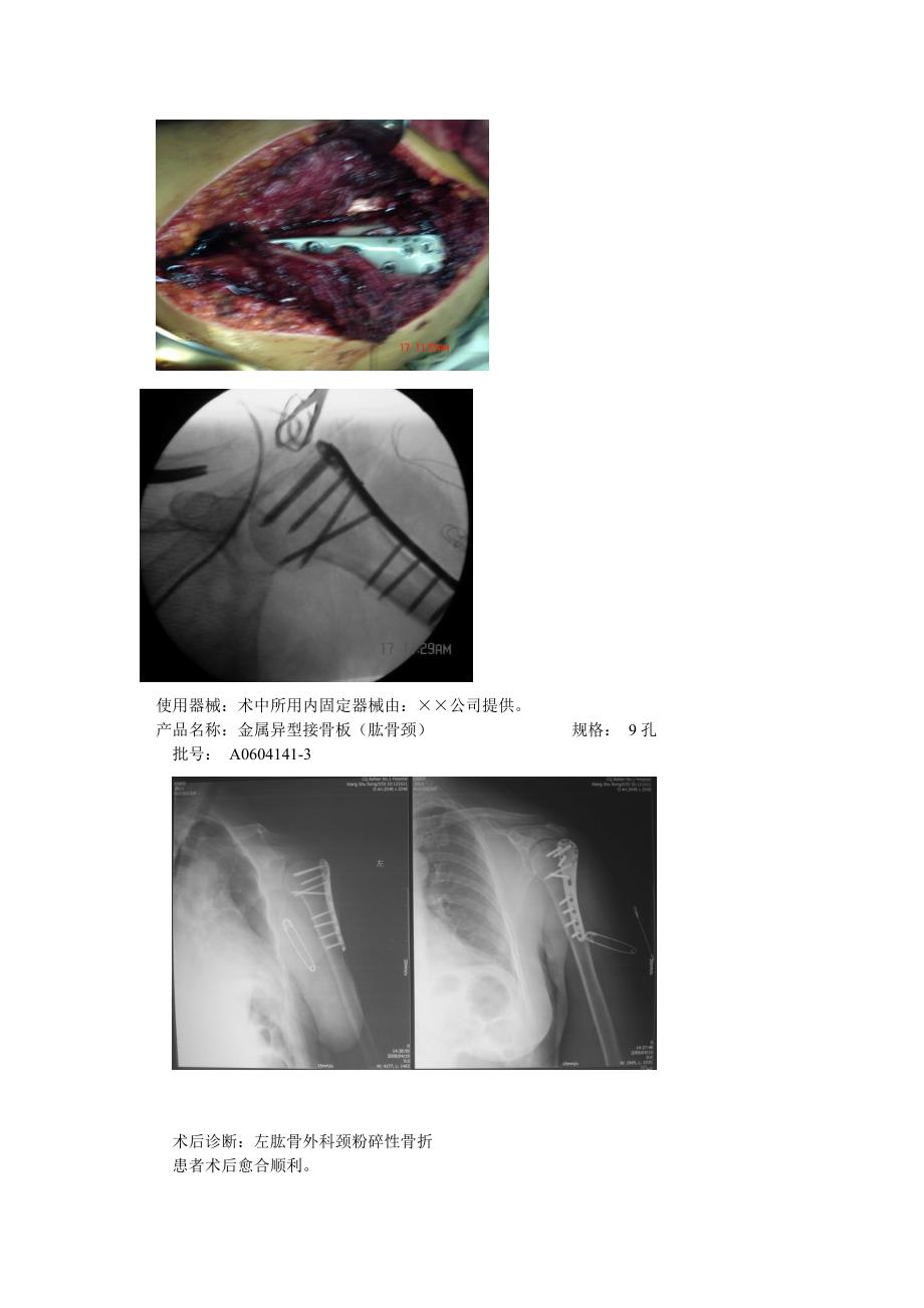 左肱骨外科颈骨折,锁定钢板螺丝钉固定_第2页