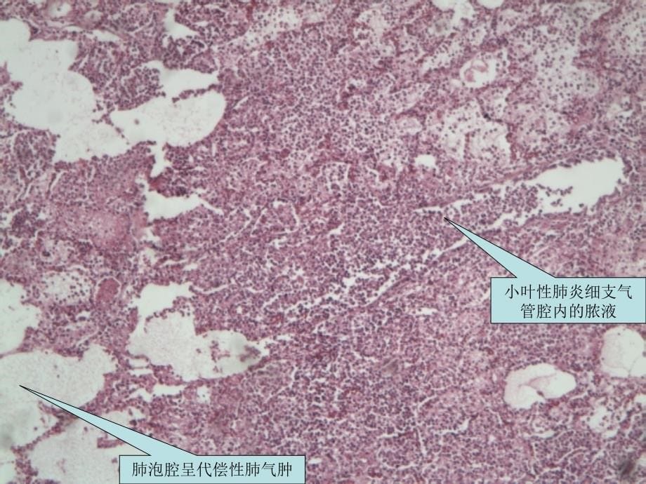 呼吸系统疾病示范教学_第5页