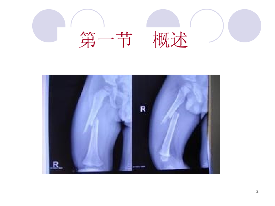 44章 骨折病人的护理1_第2页