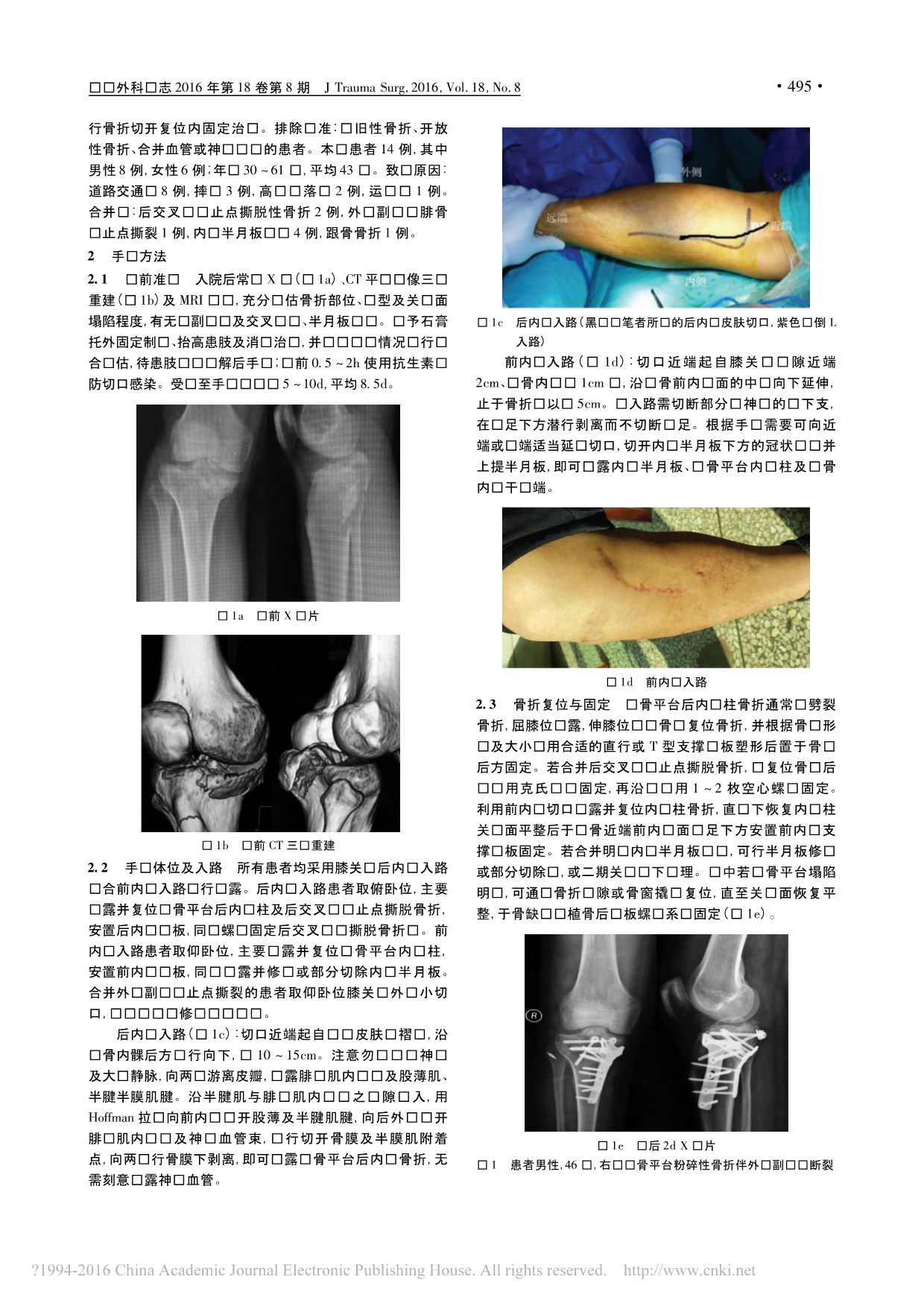 膝前后联合入路治疗复杂Schatzker_型胫骨平台骨折_唐飞_第2页