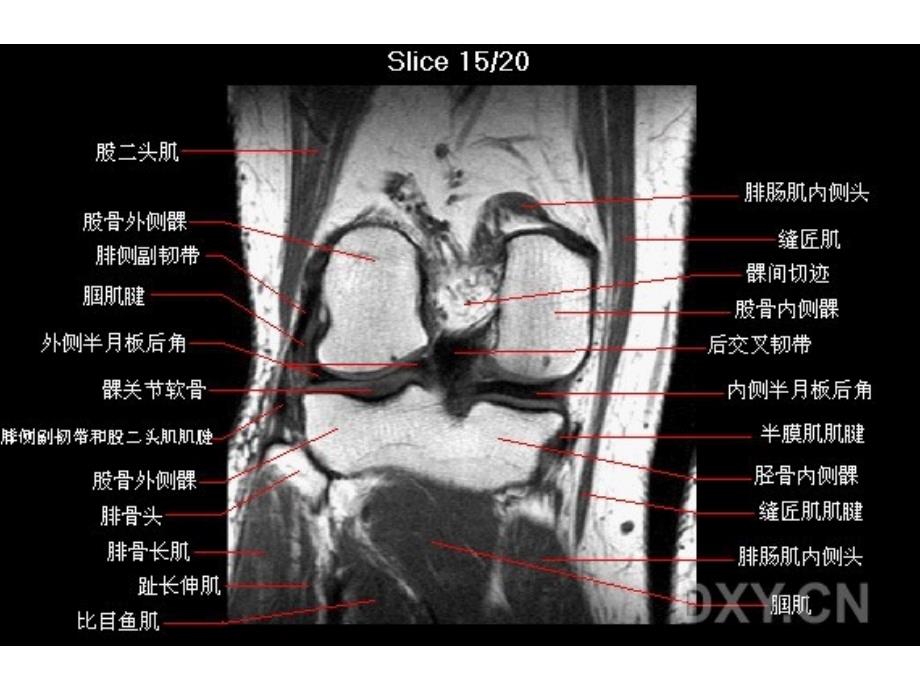 膝部MRI解剖 医学课件_第3页