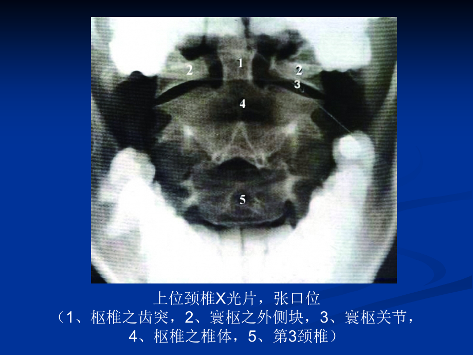 脊柱的影像学诊断_第4页