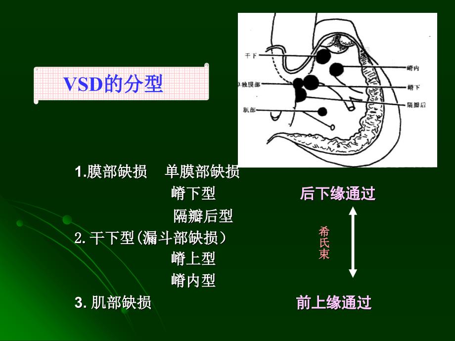 心脏直视手术后心律失常_第4页