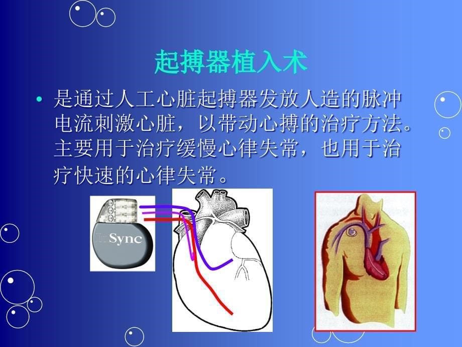 心律失常介入治疗_第5页