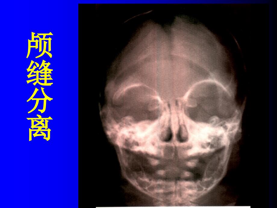 3.影像本科-NS基本病变的影像学表现_第4页