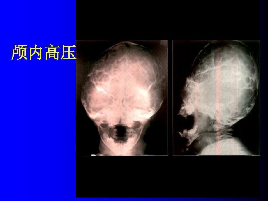 3.影像本科-NS基本病变的影像学表现_第5页