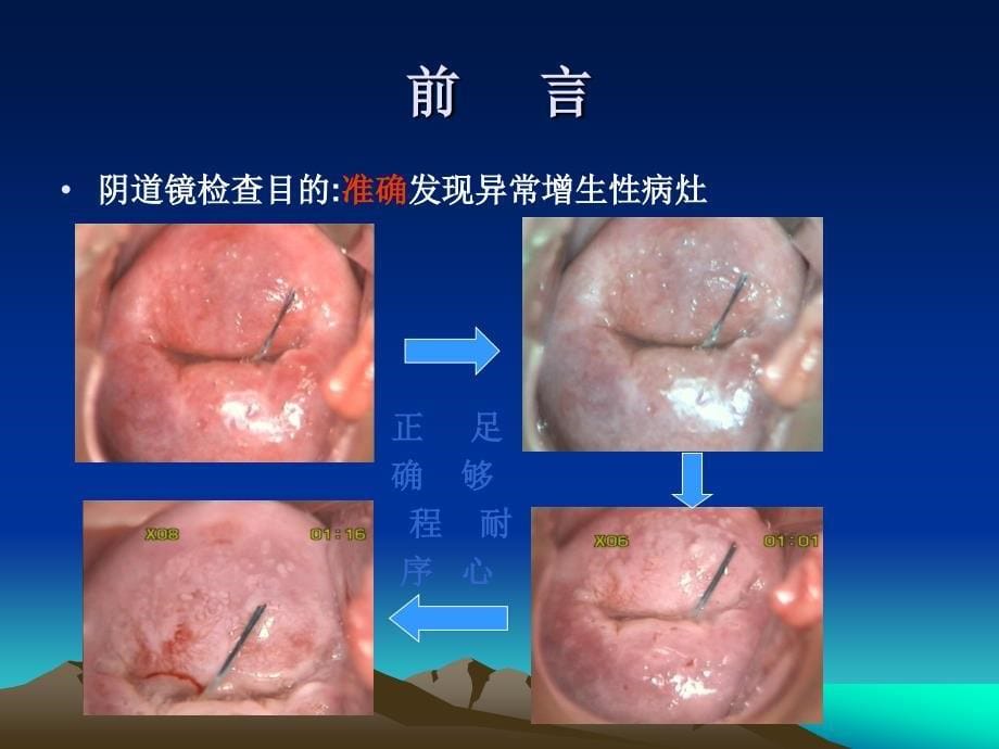 电子阴道镜在子宫颈癌筛查中的应用_第5页