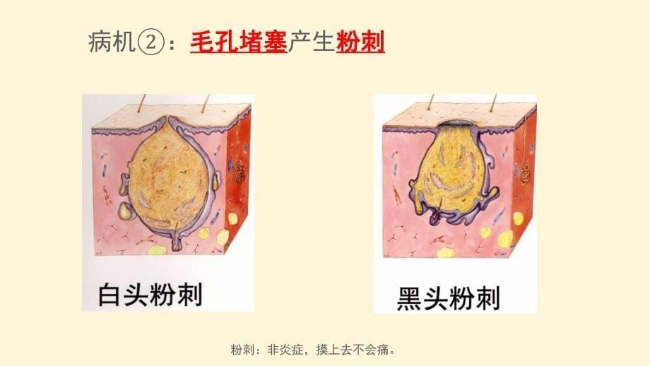 大学教授课件——祛痘_第5页