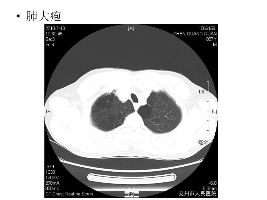 呼吸系统及纵膈CT图片_第4页