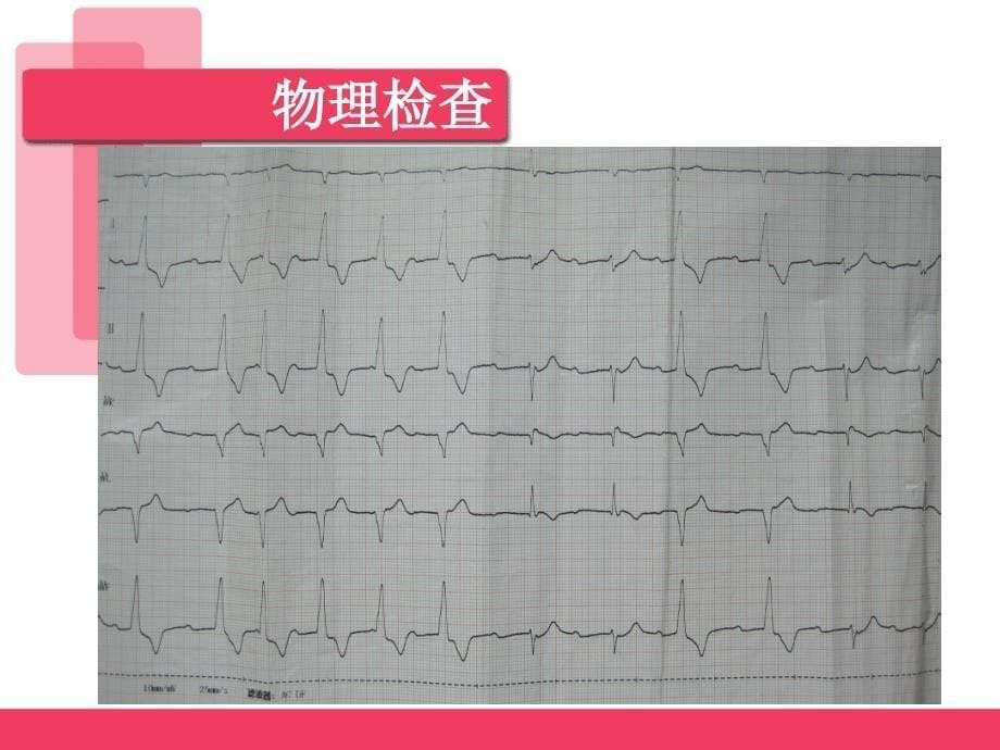 心内科抢救急性重症心肌炎1例上传版_第5页