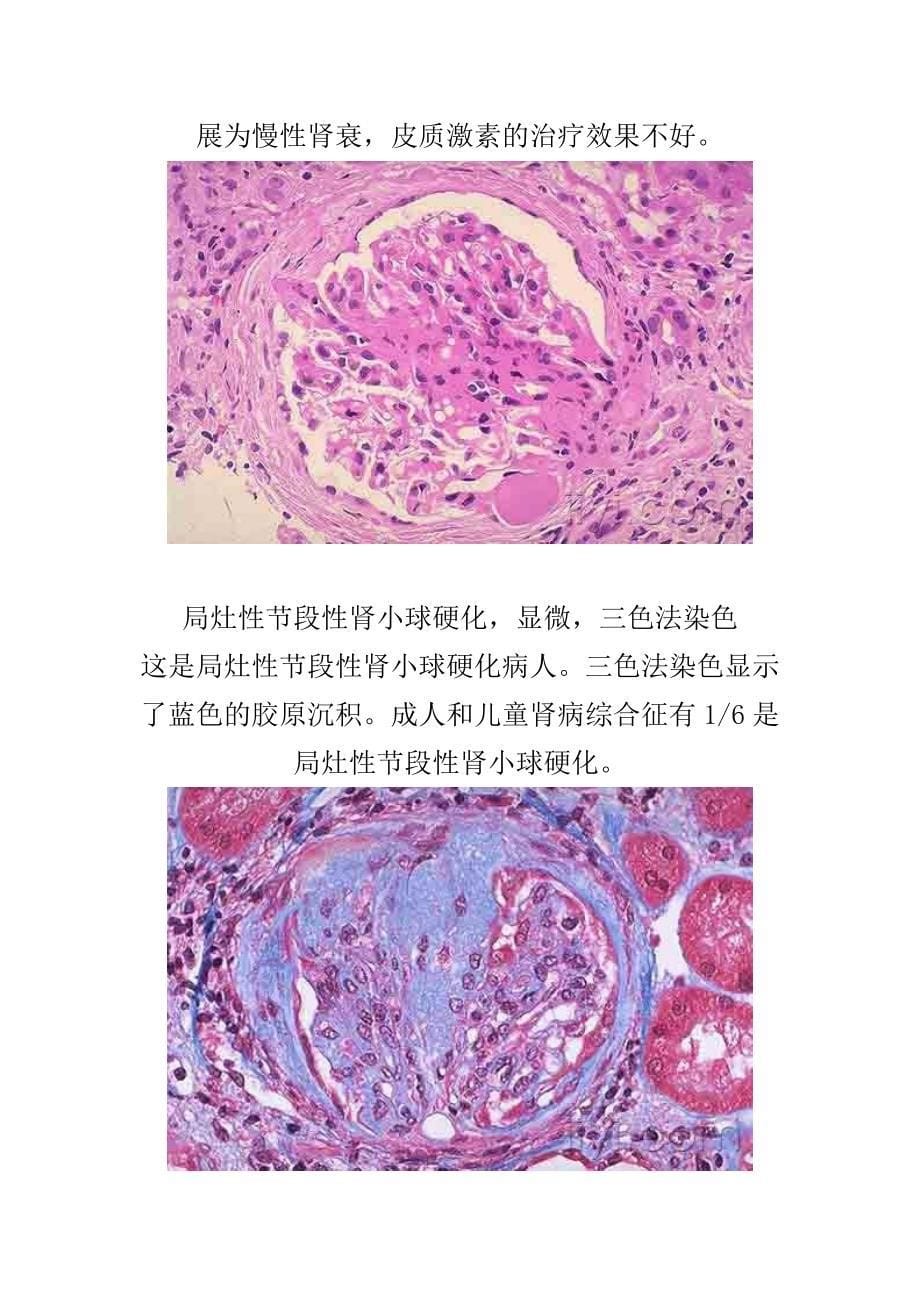 肾脏病理图片(肾小球肾炎病理图片)_第5页