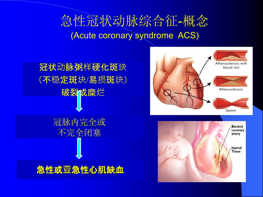 ACS危险分层和处理策略[1].ppt_第4页