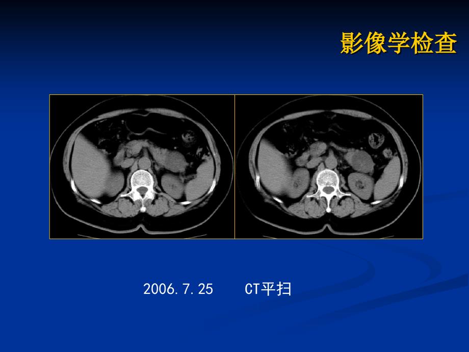 胰腺粘液性囊腺瘤病历讨论_第4页