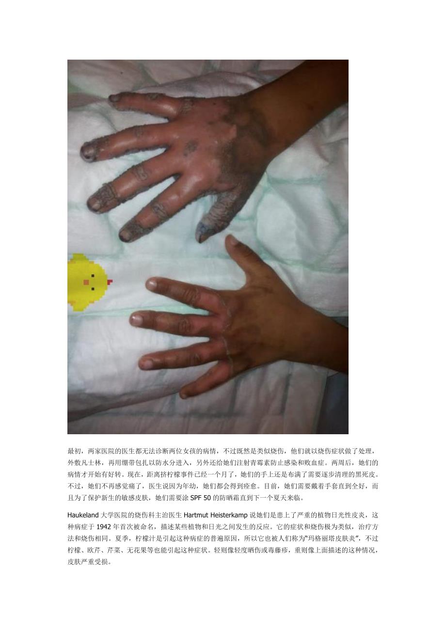 女孩阳光下挤柠檬双手被严重腐蚀_第2页