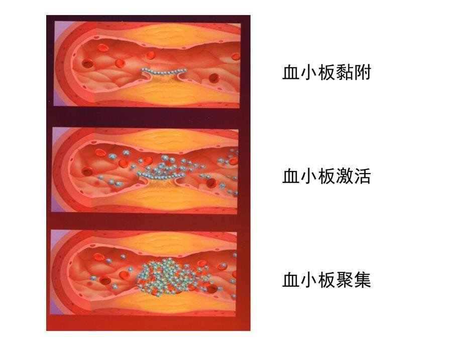 急性冠状动脉综合症_第5页