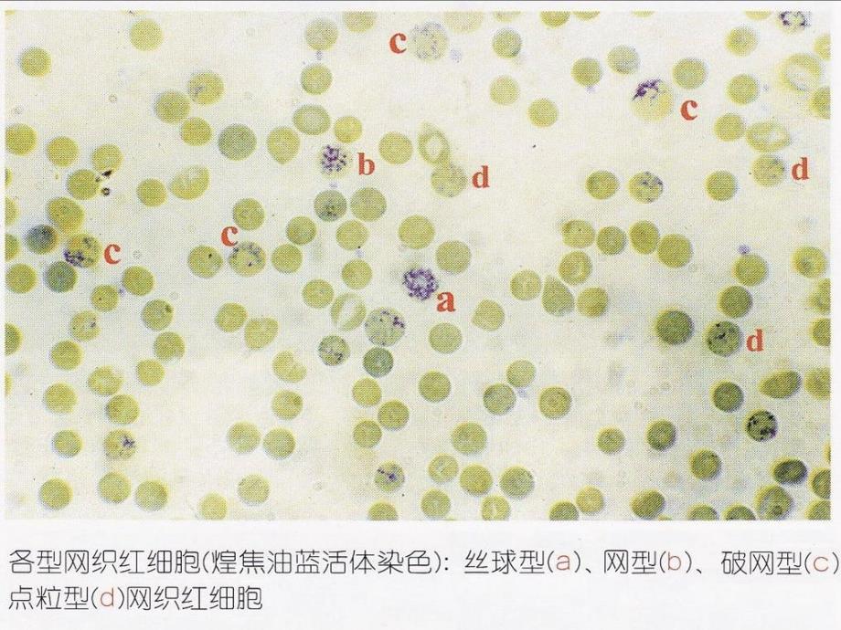 网织红细胞检测进展及其临床应用_第4页