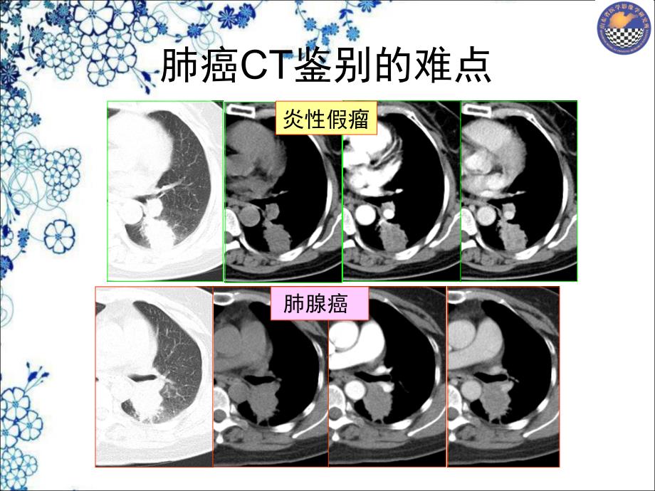 CT肺癌鉴别注意-济宁2014-8_第2页