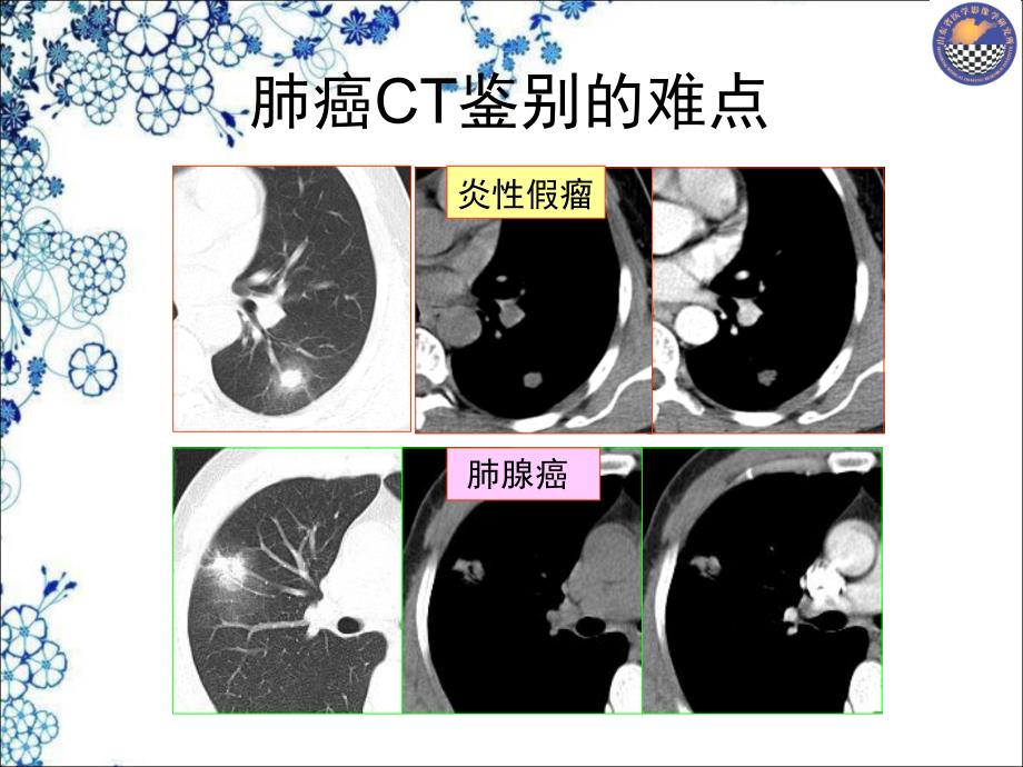 CT肺癌鉴别注意-济宁2014-8_第3页