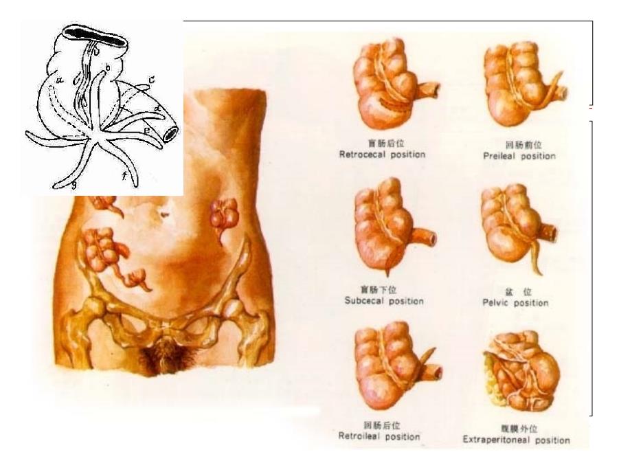 急性阑尾炎疾病患者的护理_修改后_第3页